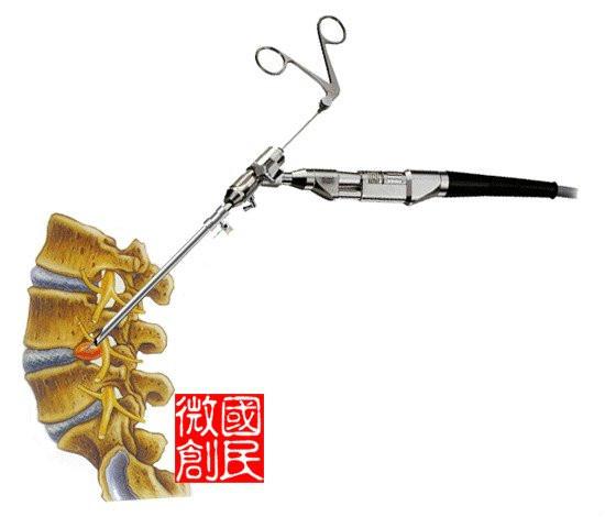 供應椎間孔鏡的費用不高